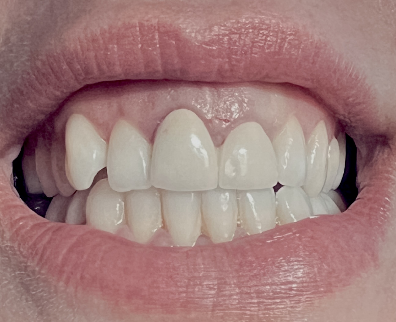 Porcelain veneers before treatment